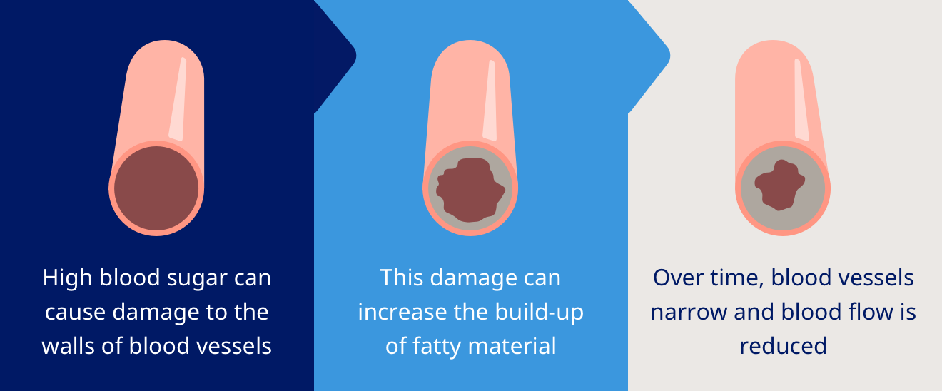 DIABETES, STROKE AND CARDIOVASCULAR DISEASE